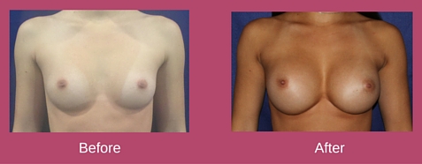 Copy of Breasts 1