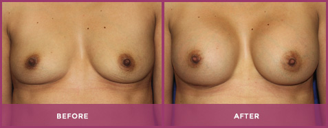 breast augmentation palm desert