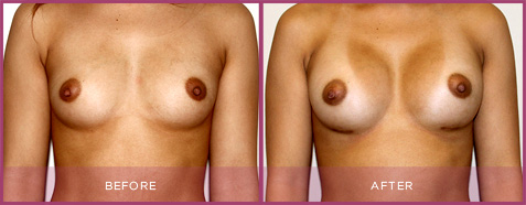 breast augmentation SG valley