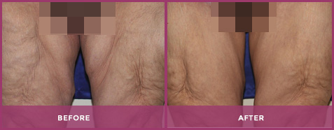 thigh lift pasadena