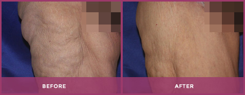 thigh lift palm desert